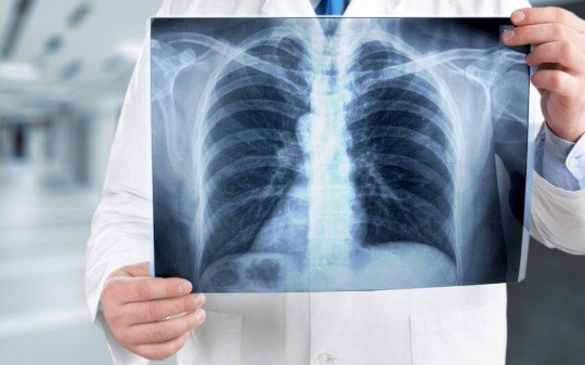 В Одинцово врачи спасли мужчину с коронавирусом и 100% поражением лёгких