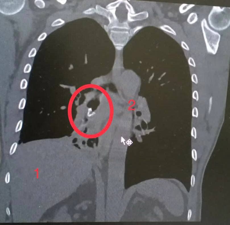 Снимок, В Одинцово врачи извлекли из бронхов пациента фрагмент птичьего шейного позвонка