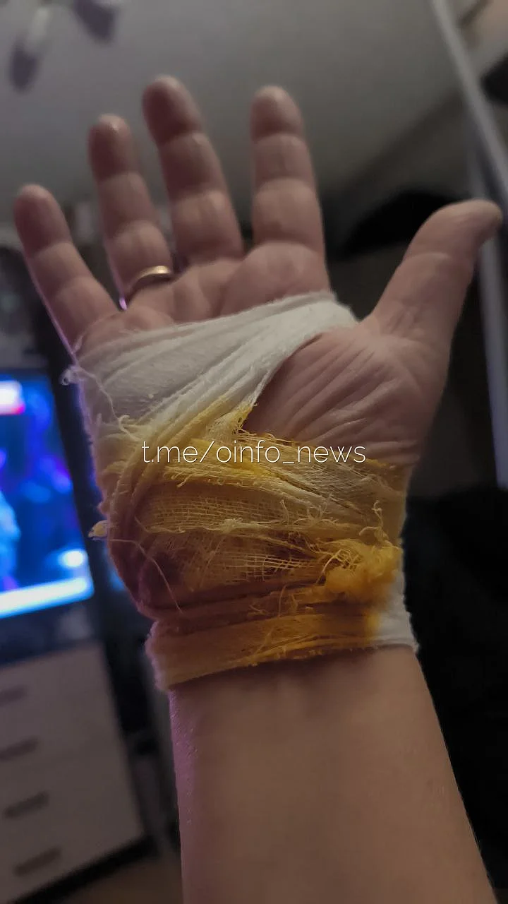 Рука пострадавшей женщины, В Трёхгорке хозяйка собачки пострадала от пса породы кане-корсо, защищая своего питомца